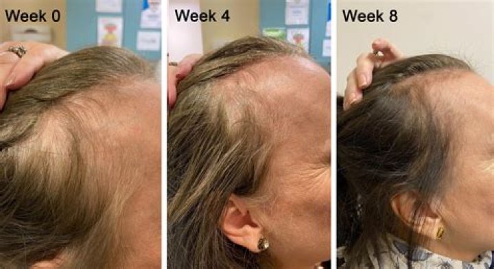 Hair Loss for Women, While as Common as for Men, Carries Extra Worries